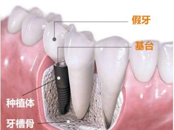 成都锦江极光口腔医院种植牙有哪几种  有哪些优点呢