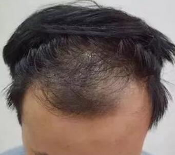 郑州大学第二附属医院植发科做头发种植多少钱
