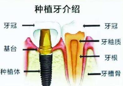 合肥美奥口腔整形医院种植牙有哪些优势  有哪些危害