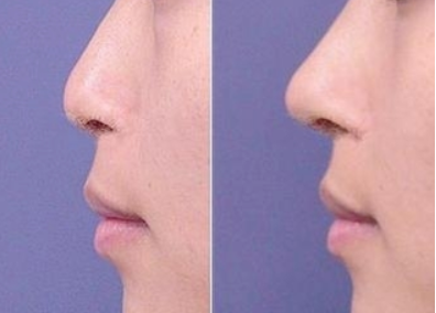 长沙温宏整形医院鼻子整形对比图 自体软骨隆鼻价格
