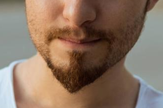 厦门<font color=red>新生植发</font>整形胡须种植的费用怎么算 　胡须种植的护理