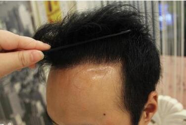 杭州天大植发整形医院头发种植的效果怎么样  多久看到效果