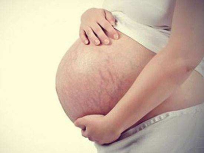 温州瓯海梦露整形激光祛妊娠纹 安全呵护女人美好岁月