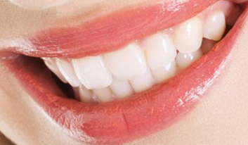牙齿矫正有哪些误区 上海美维口腔门诊部牙齿的矫正方法