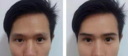 上海华美植发整形医院植眉毛一般要多少钱 多久能看见效果