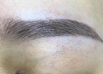 眉毛变浓密的方法 厦门碧莲盛植发整形医院眉毛种植的优点