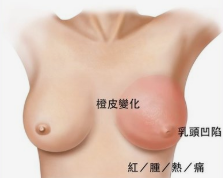  的乳头乳晕形态北京安仁医院整形乳头内陷的矫正