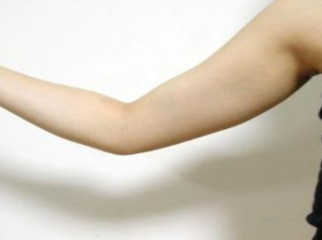 吸脂手臂的效果 杭州世彩整形医院吸脂有多种优势