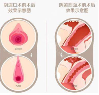 湘潭仁和医院医疗美容整形科阴道紧缩手术恢复时间
