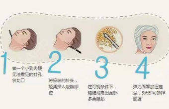 面部吸脂有什么优势 北京华韩整形医院面部吸脂如何操做 