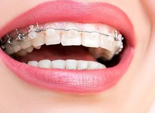 矫正牙齿要多少钱 重庆美维口腔医院矫正牙齿贵不贵