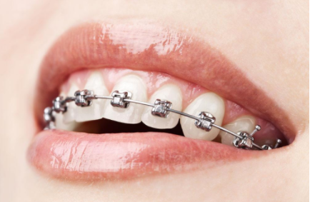 去牙科矫正牙齿贵吗 济南圣贝口腔整形医院矫正牙齿的方法