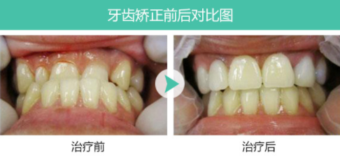 北京拜尔昊城口腔医院整形科<font color=red>牙齿矫正的年龄</font>是多大