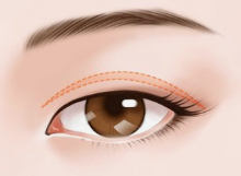 廊坊艾美整形医院不同的眼睛基础适合什么<font color=red>双眼皮手术方法</font>