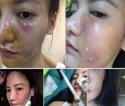 泰国美女打美容针后遗症 一组惨不忍睹的照片让人害怕