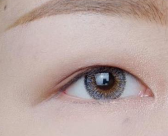 大庆蓝天整形医院做韩式三点双眼皮手术能保持多久