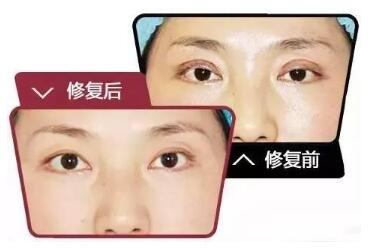 北京双眼皮修复哪家好 北京博美整形医院双眼皮修复优势