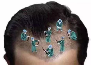 北京毛发移植医院哪家好 植发的效果能维持多久