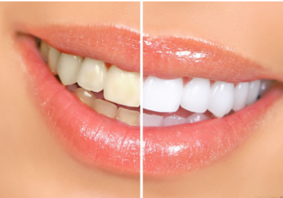 怎么能美白牙齿 昆明激光美白牙齿需要多少钱