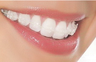 上海圣贝做冷光牙齿美白需要多少钱 大概能保持几年