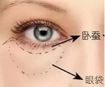 深圳永秀整形医院激光祛眼袋需要多少钱 给你气质美眼