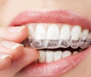 重庆做成人牙齿矫正多少钱 整齐的牙齿更能提升您的气质