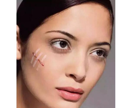 汕头爱丽诺皮肤美容科做激光祛疤多少钱 对哪些疤痕有效