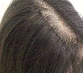 北京联合丽格植发医院头发移植的成功率高不高 告别脱发