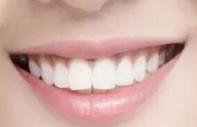 成都金琴牙科美白牙齿效果能保持多久 美白价格贵吗