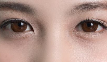 北京优尔整形医院激光祛眼袋的效果如何 享受年轻的感觉