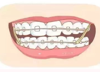 衡阳美莱口腔医院牙齿矫正什么时候做比较好 要拔牙吗