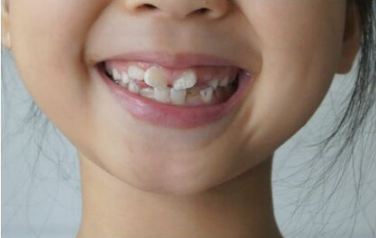 牙齿矫正有黄金年龄段吗 上海东奥口腔医院矫正牙齿价格