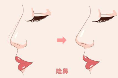 广州番禺更自信整形医院假体隆鼻 拥有高颜值的面容