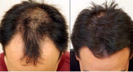 郑州美莱植发医院种植头发多少钱 多久能恢复