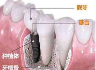 上海<font color=red>种植牙</font>大概多少钱一颗 长期缺牙有哪些危害