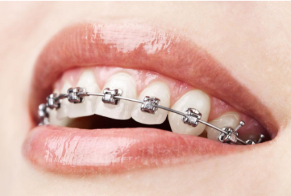 成人可以做牙齿矫正吗 整齐的牙齿 有效提升您的形象
