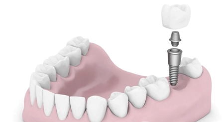 广州德伦口腔整形医院种植牙优势 种植牙能使用多少年