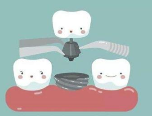 昆明德韩口腔医院种植牙的操作过程 种出一口好牙