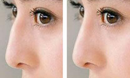 合肥驼峰鼻矫正有哪些方法 轻松摆脱畸形鼻子