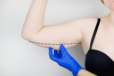 女人如何拥有纤细手臂 手臂吸脂术是您不二的选择