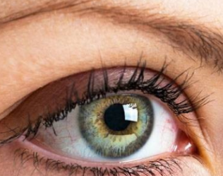 上眼睑松弛的分类 重庆晶肤整形医院上眼睑下垂矫正方法