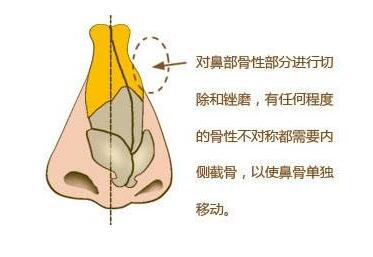 上海同德整形医院歪鼻矫正效果好吗 适应人群有哪些