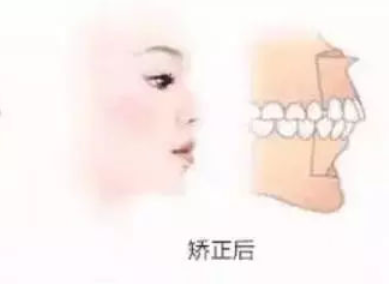 地包天矫正后遗传 沈阳拜博口腔医院地包天牙齿矫正的方法