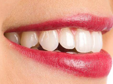 宜兴华美整形牙齿矫正有什么优点 需要钢丝吗