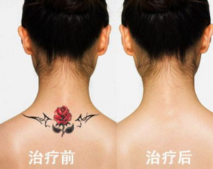 激光洗纹身哪家好 北京艾菲美容整形诊所洗纹身