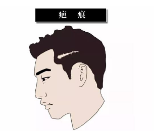 上海美莱毛发移植医院植发多少钱 疤痕植发效果好吗