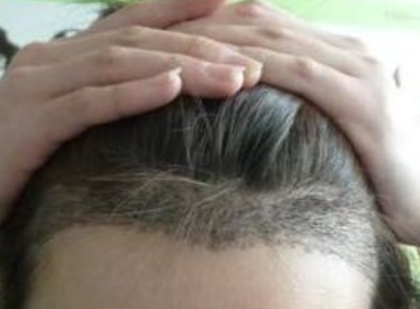 北京植发专业 和谐美丽汇整形诊所头发种植的效果