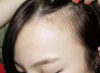 上海江城毛发移植头发种植靠谱 正规整形科专业