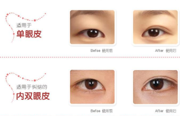 杭州吉奥医疗美容门诊部双眼皮整形术后恢复自然的方法