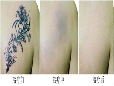 青岛市海慈医院整形美容激光洗纹身的优点  会不会留疤